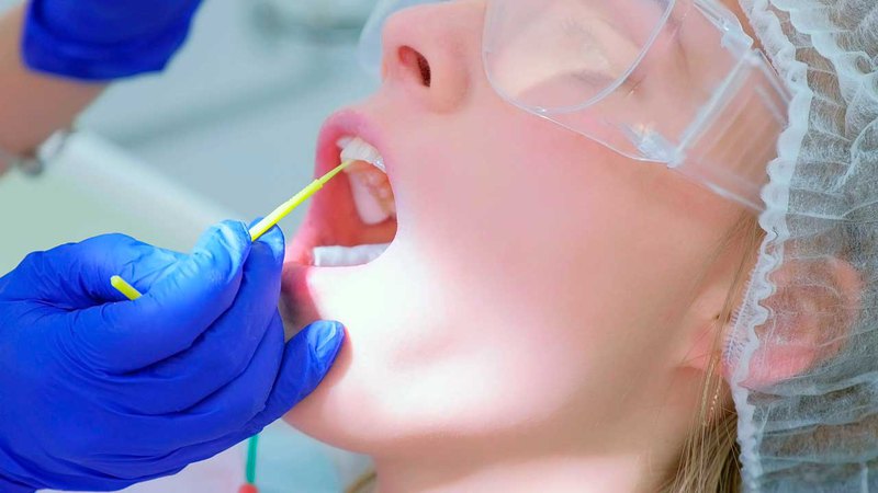 A women during fluoride treatment process with her mouth open.