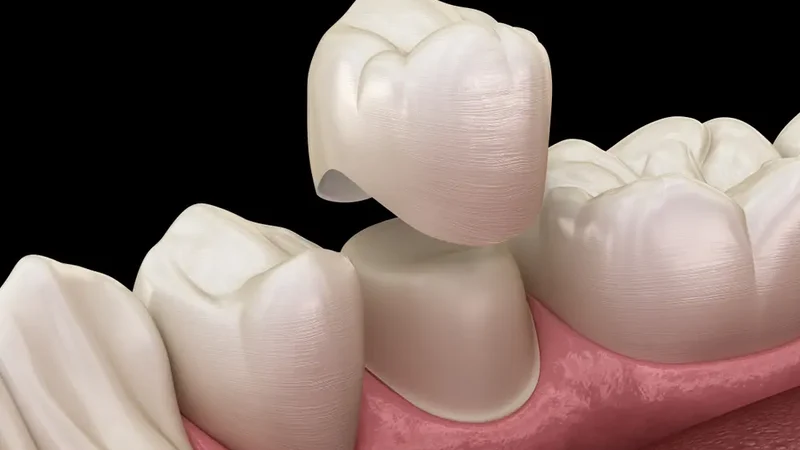 The assembly of a ceramic crown on a premolar tooth, restoring both function and aesthetics.