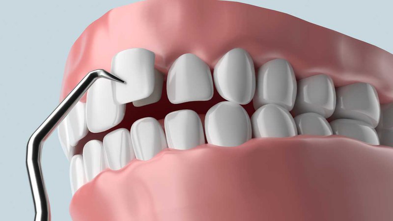 Installing dental veneers is a simple procedure for the experienced dentist at our center