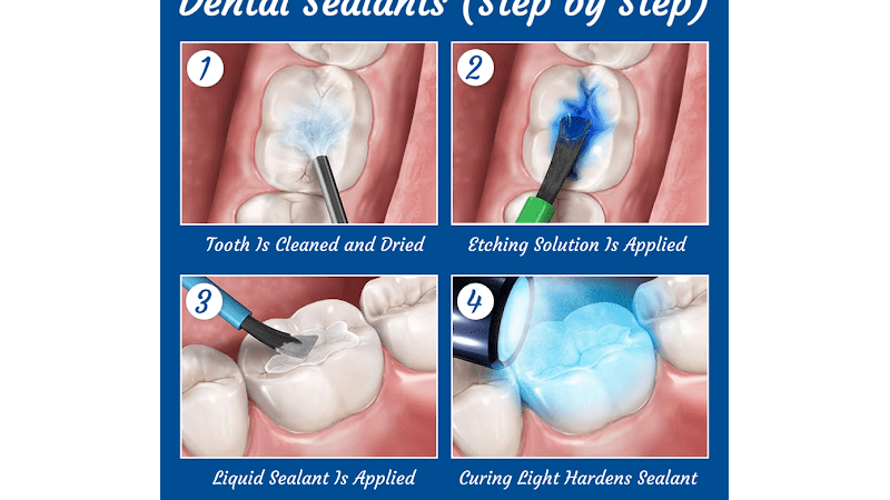 How To Apply Dental Sealant - King of Prussia Dental™ Associates